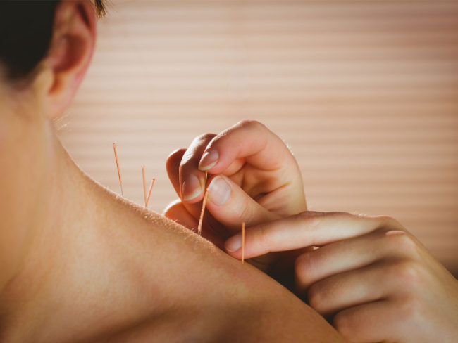 acupunture