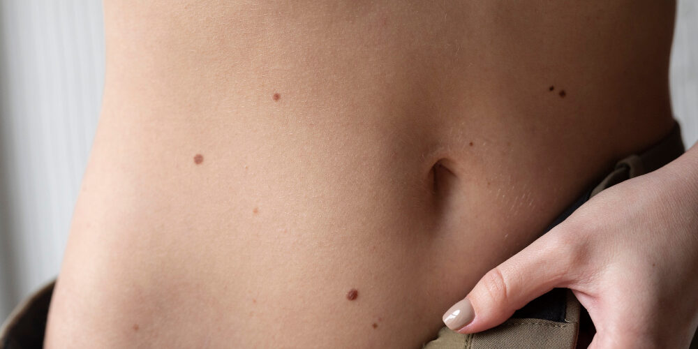 woman-with-melanoma-her-skin